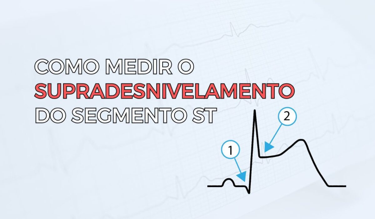 Eletrocardiogrma com ritmo de escape juncional
