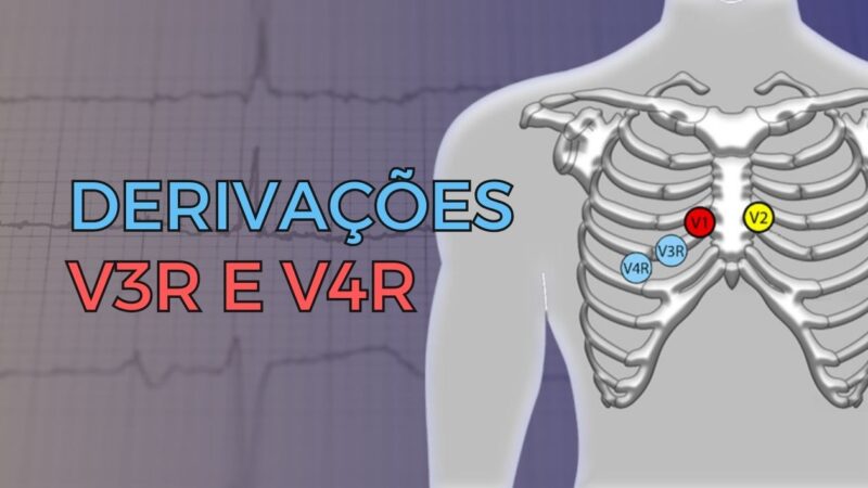 Eletrocardiograma com troca de eletrodos