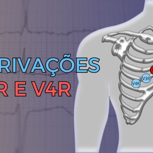 Algoritmo EPM utilizado para localização de vias acessórias no eletrocardiograma