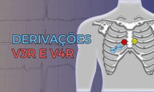 Eletrocardiograma com dextrocardia