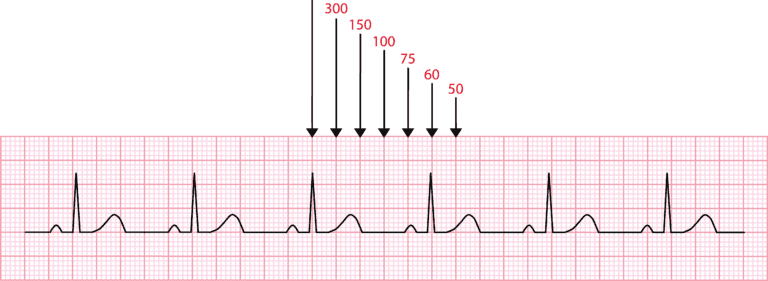 Eletrocardiograma com pré-excitação ventricular e onda delta