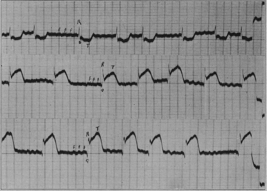 Derivações eletrocardiográficas v3r e v4r