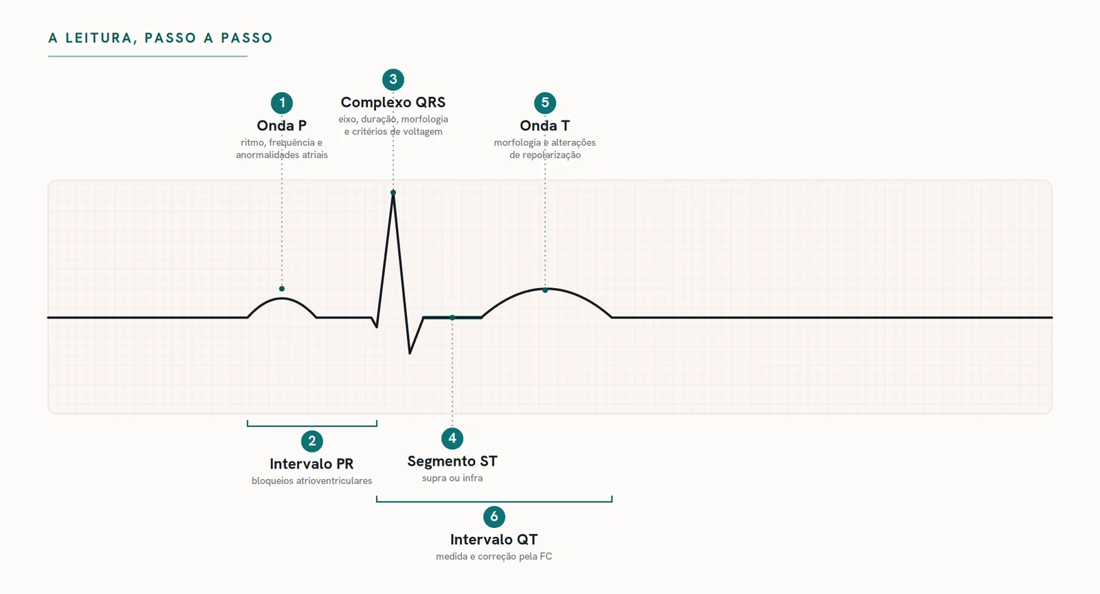 A leitura do ECG passo a passo: onda P, intervalo PR, complexo QRS, segmento ST, onda T e intervalo QT anotados sobre um traçado